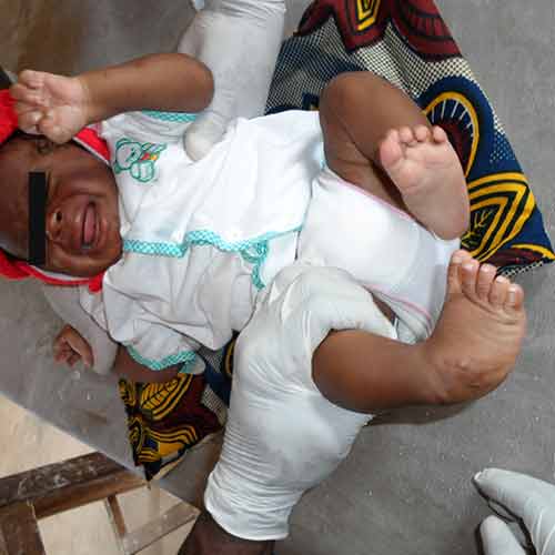 club_foot