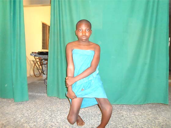 clubfoot nkst rehabilitation treatment